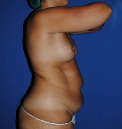 diastasis abdominal antes de la operación de abdominoplastia
