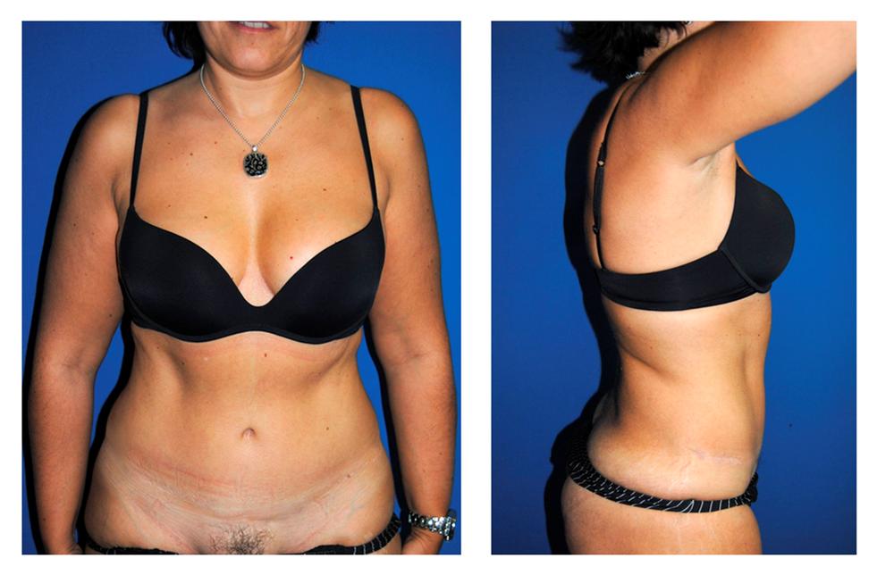 diastasis abdominal despues de cirugia abdominoplastia