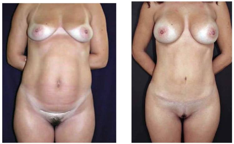 umbilicoplastia antes y despues